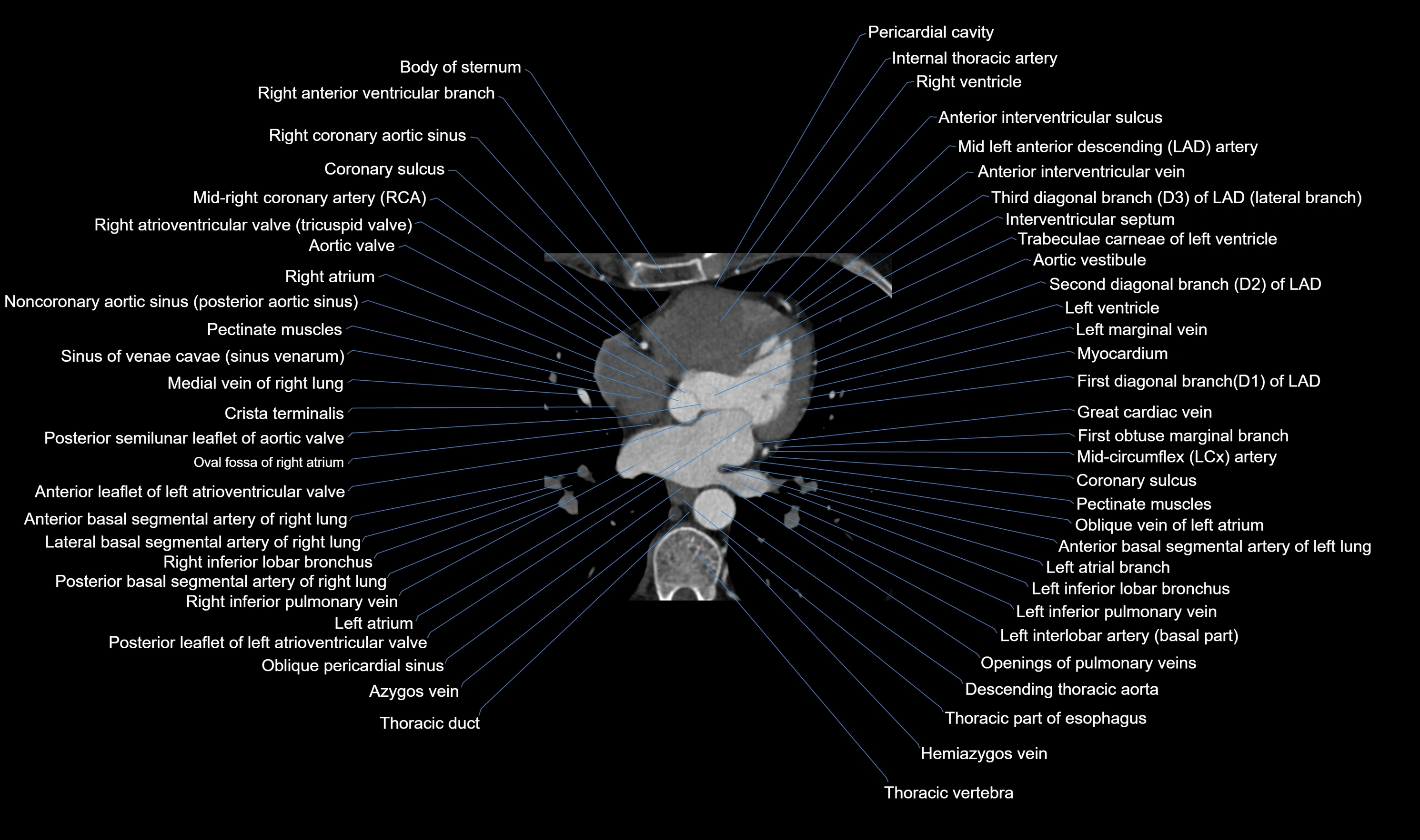 CT heart (coronary angiogram) axial view cross sectional anatomy labelled radiology image-00033.webp